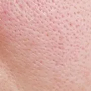 Cận cảnh vùng da thiếu ẩm, bề mặt thô, lỗ chân lông lộ rõ