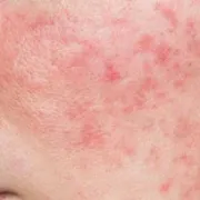 Cận cảnh vùng má ửng đỏ, có mẩn nhỏ