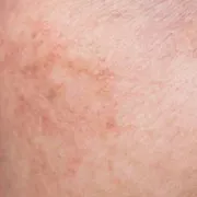 Cận cảnh vùng gò má sạm màu lan tỏa do nắng
