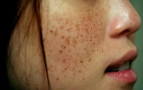 Nám chân sâu dạng nốt nâu xám bờ mờ