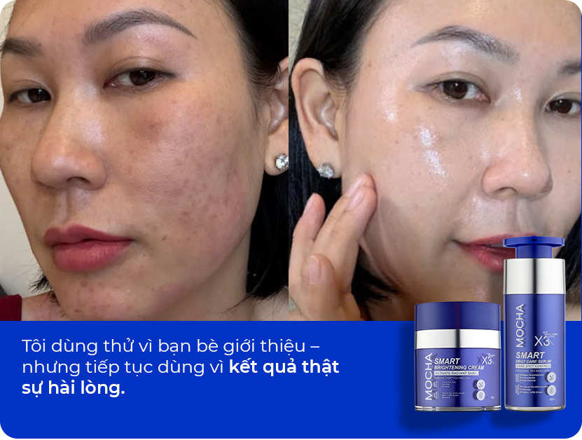 Cải thiện da nám