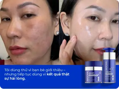 Cải thiện da nám