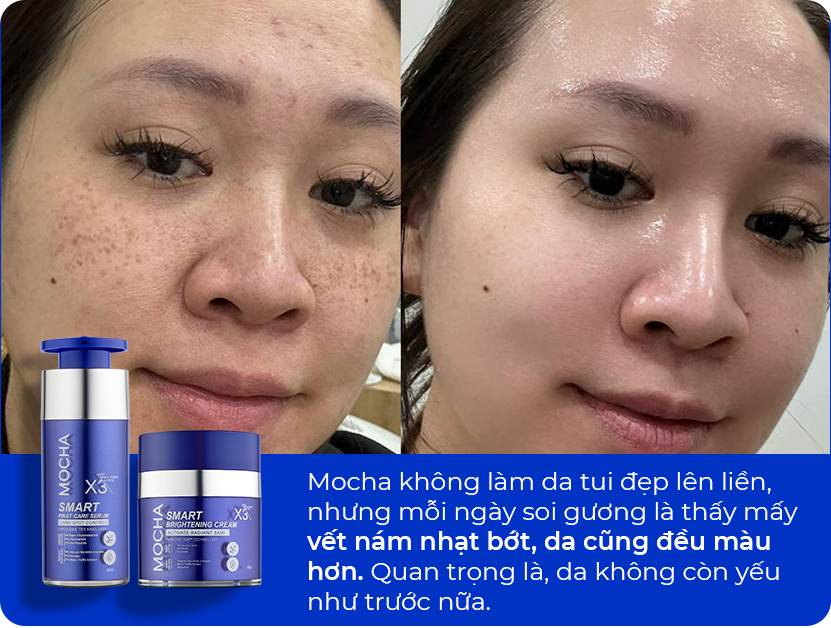 Nám nhạt dần và da đều màu hơn