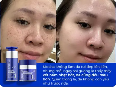 Nám nhạt dần và da đều màu hơn